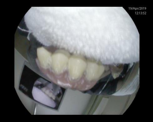 השיניים שתועדו במקרה בלניאדו. צילום: דוברות בית החולים לניאדו